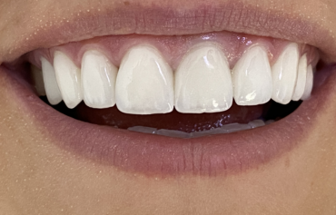 Teeth Whitening